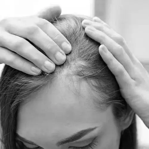 The Benefits of Scalp Micropigmentation for People with Alopecia