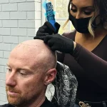 The Benefits of Scalp Micropigmentation for Scar Camouflage
