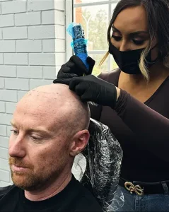 The Benefits of Scalp Micropigmentation for Scar Camouflage